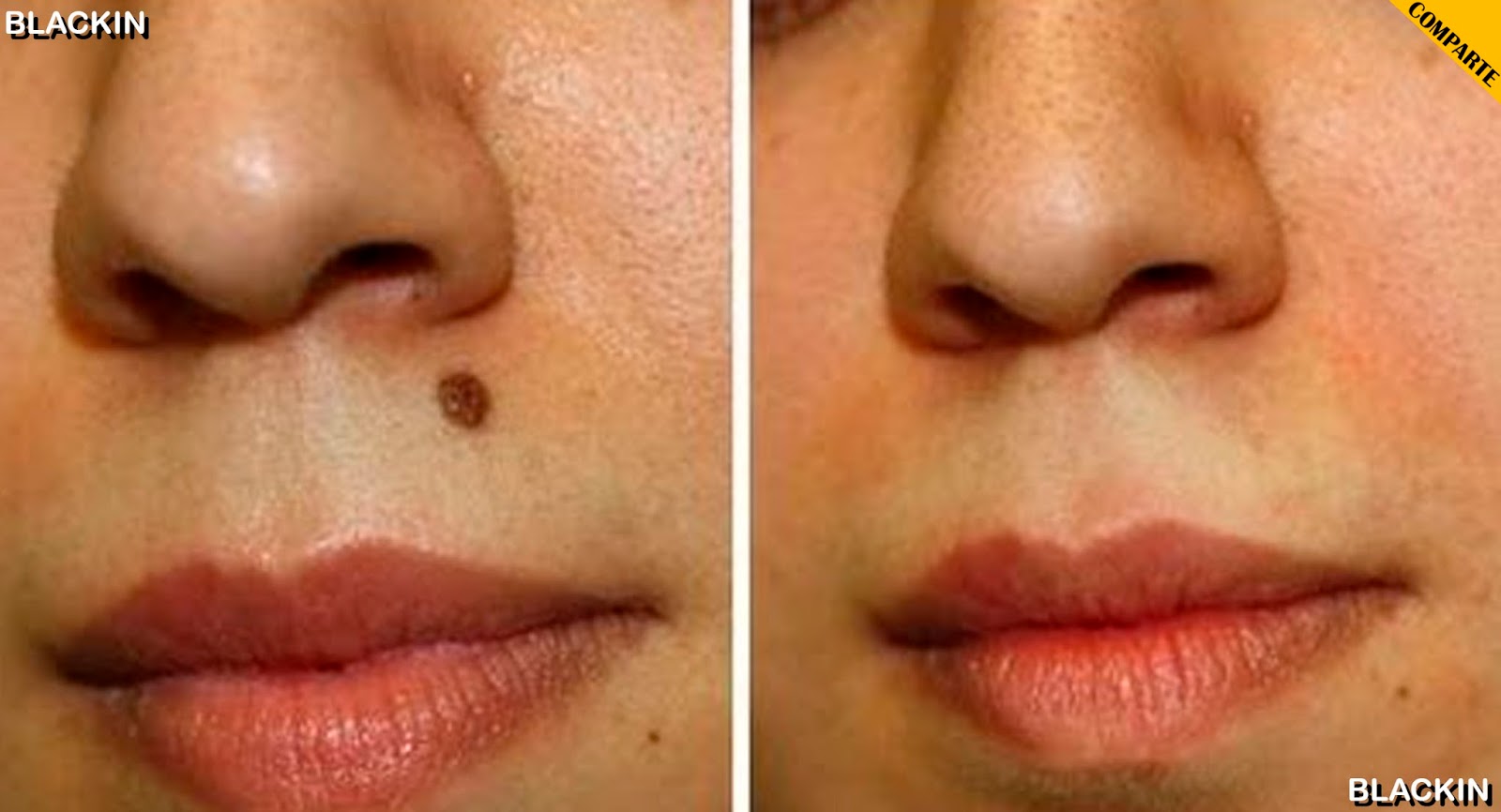 De forma natural quitar lunares