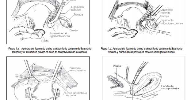 Histerectomia total tecnica quirurgica pdf