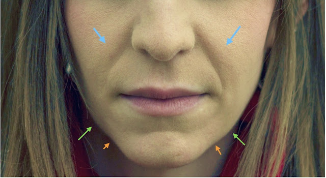 Efecto de la edad en los pómulos La imagen muestra el descolgamiento de los pómulos produce surcos marcados en los laterales de los labios (flechas azules). Además aparece tejido que desciende de la línea mandibular (flechas verdes) que en el lenguaje cotidiano se conocen como "cocochas". En contraposición con la barbilla, se produce un hundimiento, acentuando más la pérdida de contorno (flechas naranjas)