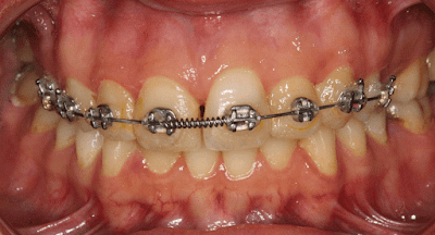 Başka bir ortodontist tarafından tedavi edilen bir hastanın ağız içi fotoğrafı. Geleneksel braketlerin çevresindeki sararmış elastik halkalar görülmektedir. Hatta kesici dişteki braketin çevresindeki lastik tam takılmamış durmaktadır!