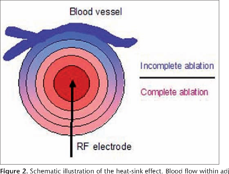 EXAMS AND ME Radiofrequency Ablation