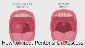 How to Treat Peritonsillar Abscess How to Treat Peritonsillar Abscess