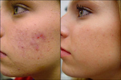 acne removal