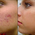 Closed how acne removal