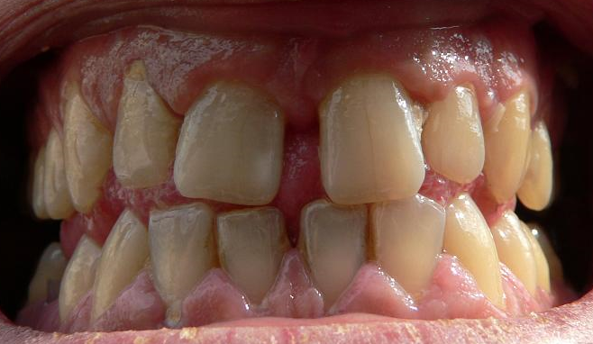 Periodontal hastalık. Hastalığın belirtileri Periodontal hastalık. Hastalığın belirtileri