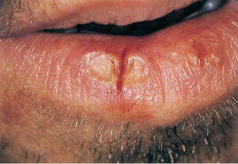 Oral steroids for allergic dermatitis