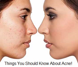 Acne Skin Care Causes & Treatment Acne Skin Care Causes & Treatment