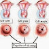 Một số dấu hiệu bệnh ung thư cổ tử cung