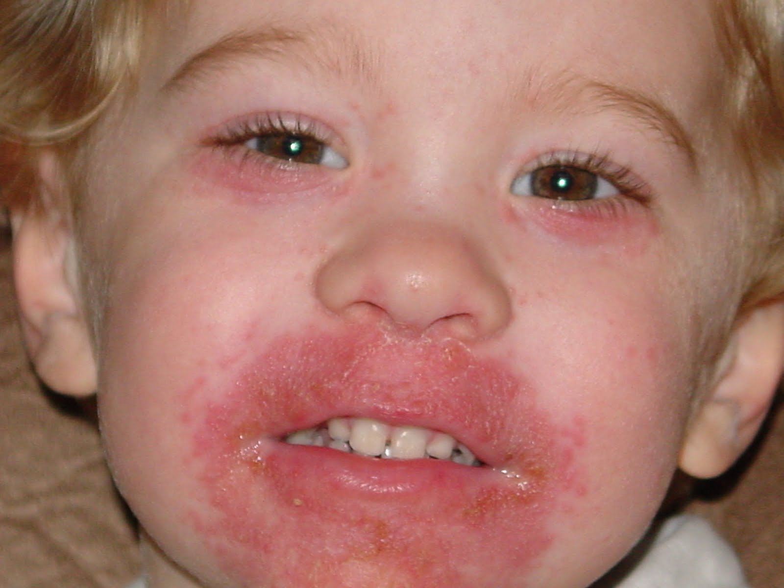 Perioral Dermatitis Drbeckmann