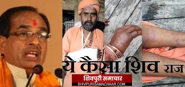 ये कैसा शिव राज :SDM का पुजारियों पर कहर, महंत का हाथ तोड़ा, पूरे शरीर पर लठठों के निशान | Shivpuri News