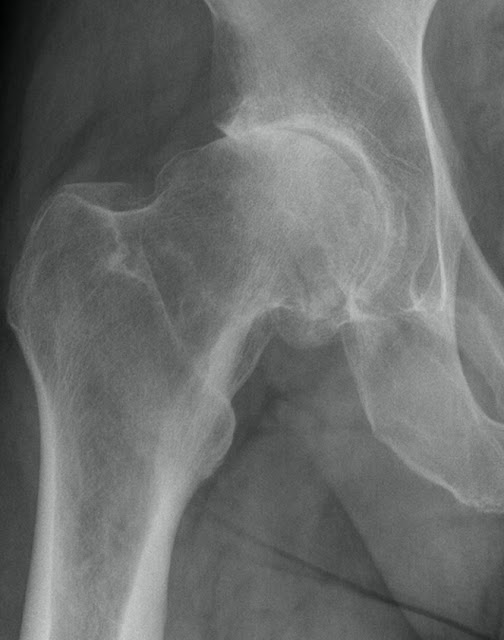 Photons and Electrons My Minimally Invasive Total Hip Replacement With