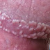 Obat Perontok Kutil Kelamin thumbnail