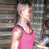 Girl Mistakenly Bathed With Acid On Her 14th Birthday In Lagos State