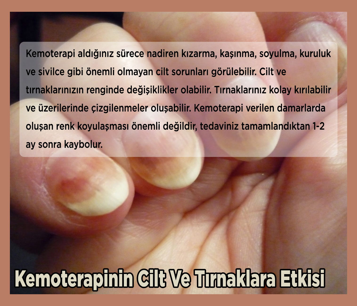 Ciltte Kendiliğinden Oluşan Çürükler Ciltte Kendiliğinden Oluşan Çürükler