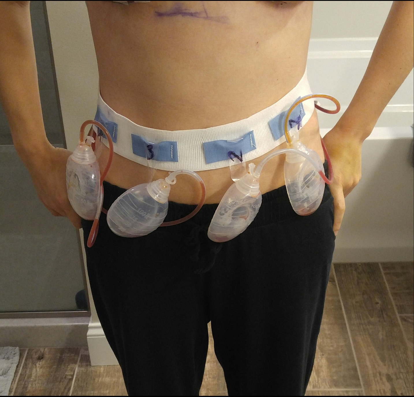 Brca 1 positive and my choice of a prophylactic double mastectomy