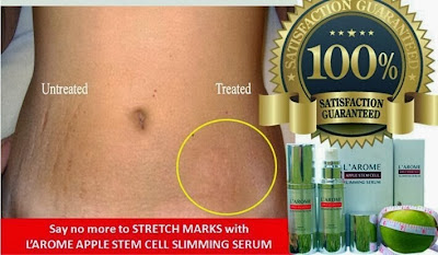 Cara Menghilangkan Stretch Mark Setelah Melahirkan cara menghilangkan stretch mark setelah melahirkan