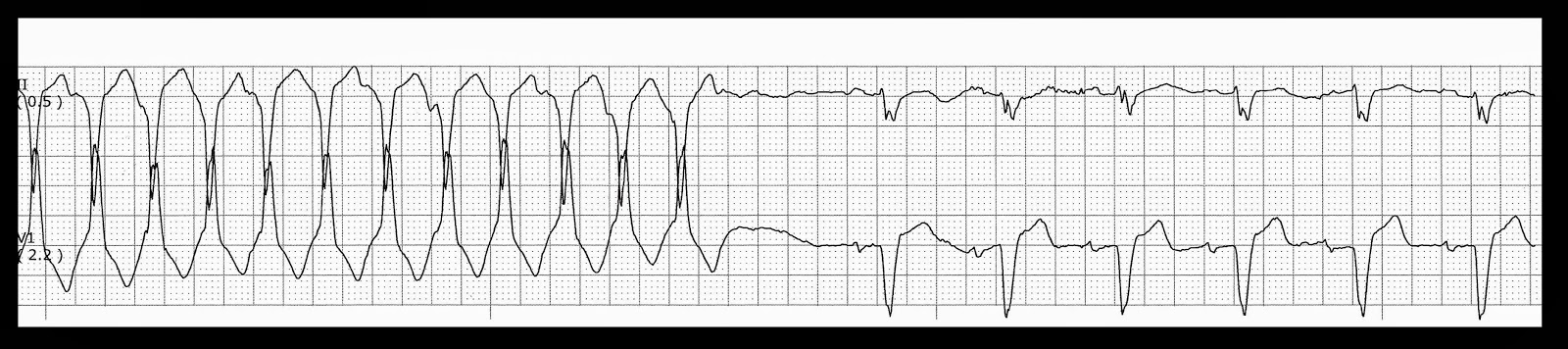 Various Ventricular Tachycardias