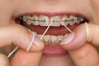 Niềng răng có những lợi ích gì?