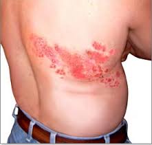 herpes herpes zozter
