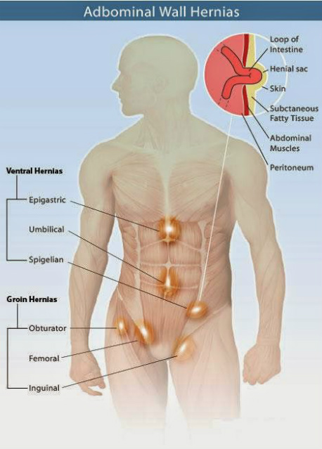natural tips to treat hernia natural fitness tips how do hernias form
