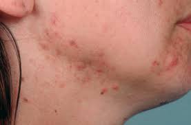 Vous pouvez supprimer  l'acné rapidement en utilisant des  méthodes naturelles