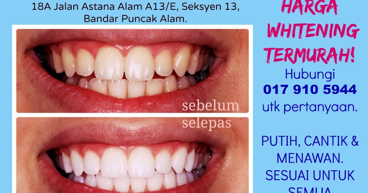 Putihkan Gigi Di Klinik / Pondok Gigi - Klinik Gigi & Dokter Gigi