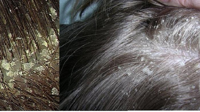 Cara Menghilangkan Ketombe Cara Menghilangkan Ketombe di Rambut