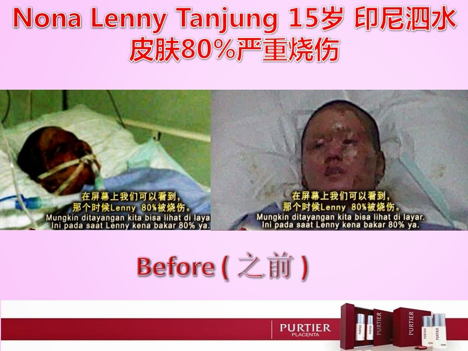 NONA LENNY TANJUNG (15) SURABAYA - 80% OF SKIN BURN