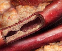 plaque layers clogging blood vessel