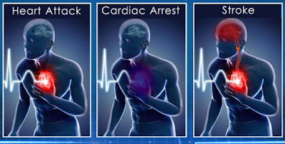 DIFFERENCES BETWEEN A HEART ATTACK, CARDIAC ARREST AND STROKE THAT YOU MUST TO KNOW