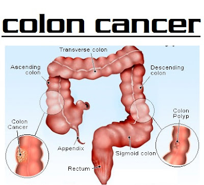 colon cancer info