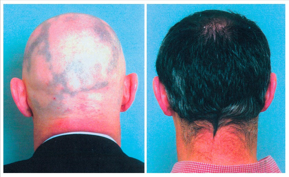 Spark Naturals Blog Alopecia Areata Essential Oil Scalp Massage