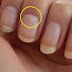 Symbol of Nails Double Colored Liver Diseases