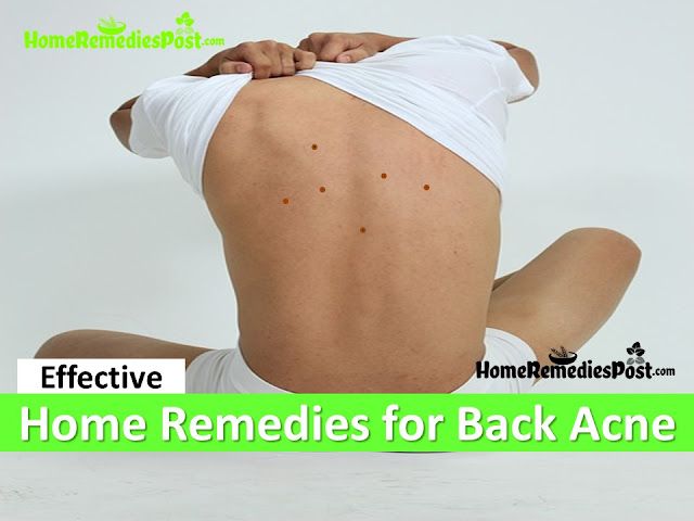 Clear acne overnight fast, How To Get Rid Of Back Acne, Get Rid Of Back Acne Fast, Home Remedies For Back Acne, back Acne Treatment, How To Cure Back Acne, Back Acne Home Remedies, How To Cure Back Acne Fast, Back Acne Remedies, How To Treat Back Acne Fast