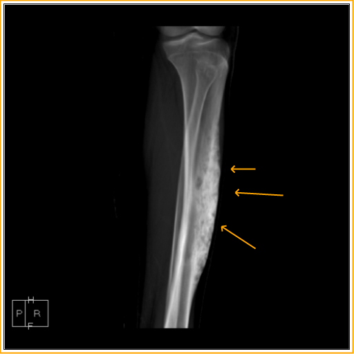 Adamantinoma Tibia Cross Sectional Imaging Sumers Radiology Blog