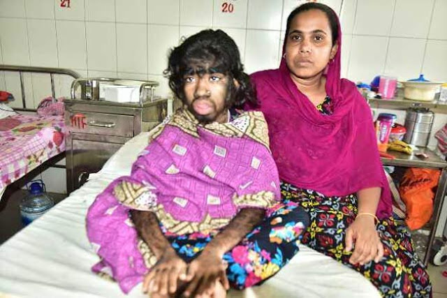 মানবতার দিকে তাকিয়ে ‘লোমশ শিশু’ বীথি মানবতার দিকে তাকিয়ে ‘লোমশ শিশু’ বীথি