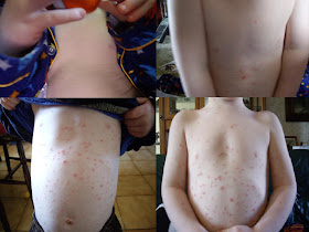 chicken pox 4 year old boy