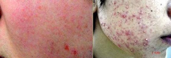 Tác hại khôn lường đến từ việc sử dụng kem trộn Tác hại khôn lường đến từ việc sử dụng kem trộn