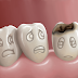 Trường hợp nào cần trám răng?