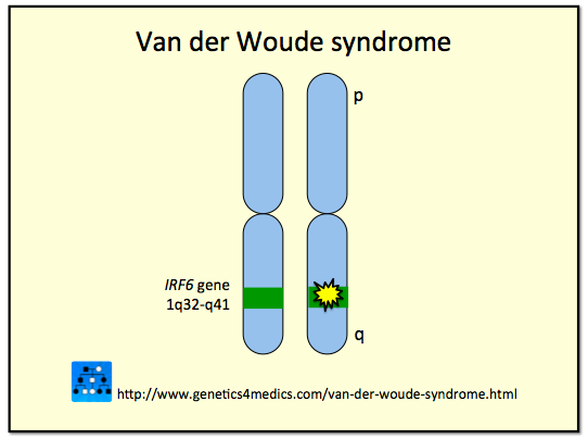 Van Der Woude Syndrome Genereviews