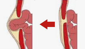 Hernies ombilicales 'Umbilical hernia' Hernies ombilicales 'Umbilical hernia'