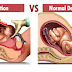 Natural Birth Vs. C-Section: Fast Facts On The Differences Between The Two