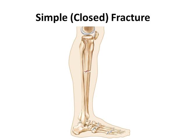 Study Bio Easily: Bone Fracture