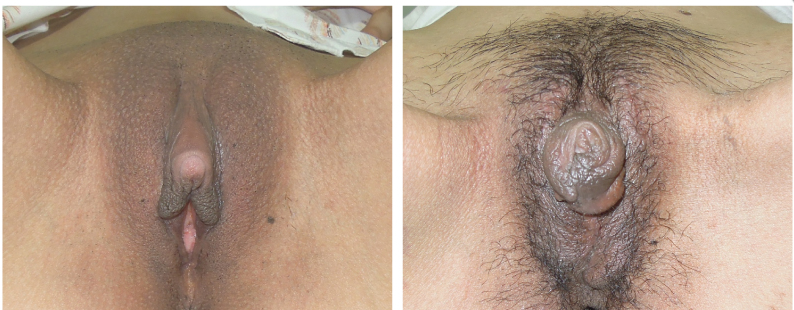 Penis to vagina surgery — photo 11
