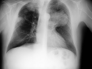 Types of Mesothelioma Types of Mesothelioma