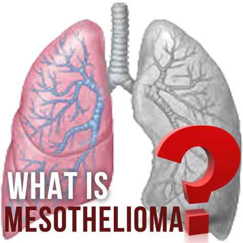 Mesothelioma: Survival Rate, Factors & Improvement Mesothelioma: Survival Rate, Factors & Improvement