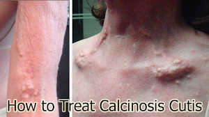 How to Treat Calcinosis Cutis How to Treat Calcinosis Cutis