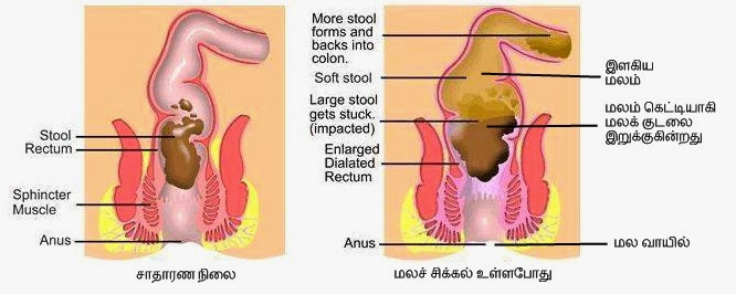    Piles (Haemorrhoids) Piles, or haemorrhoids, are areas in the anal canal where the tissue, which contains lots of blood vessels, has become swollen. They can be internal, occurring inside the anus, or external, when they can be seen and felt on the outside of the anus. When visible they look like round pink swellings, the size of a pea or a grape. Piles are common in pregnant women, but are rare in children.  What causes piles? • The primary cause of piles is chronic constipation and other bowel disorders. The straining in order to evacuate the constipated bowels and the pressure thus caused on the surrounding veins leads to piles. Piles are more common during pregnancy and in conditions affecting the liver and upper bowel. • Straining to empty the bowels when constipated.  • Chronic diarrhoea.  • Pregnancy – the weight of the foetus on the abdomen and the increased blood flow, as well as the effect of hormones on the blood vessels.  • Childbirth – pushing during childbirth increases the pressure in the veins.  • Straining to pass urine, especially in men with prostate problems.  • Cancer or growths in the pelvis or bowel, which may exert pressure in a similar way to a pregnancy. Family history – piles can run in families and are potentially hereditary, perhaps because of weak veins in the anal area.  • Obesity.  • Varicose veins – many people with these also develop piles, although piles are not varicose veins.  Other causes Other causes are prolonged periods of standing or sitting, strenuous work, obesity, general weakness of the tissues of the body, mental tension, and heredity.  Types of piles Piles are classified according to their position.  • First-degree piles remain inside the rectum or anal canal.  • Second-degree piles protrude (or prolapse) from the anus when the bowels are opened, but return of their own accord afterwards.  • Third-degree piles are similar, but only return inside when pushed back.  • Fourth-degree piles hang permanently outside the anus.  Piles Symptoms Most people affected have internal piles and may not have any symptoms at all. The earliest symptom is often bleeding of fresh, red blood from the anal passage when the bowels are opened. There may be itchiness around the anal area. Third and fourth degree piles may be more painful and tend to produce a slimy discharge of mucus that leaks from the exposed lining of the pile. There are conditions other than piles that can cause bleeding from the anus, so anyone who notices bleeding in their stool should visit a doctor for advice. • Pain or irritation while passing stools,  • Bleeding-slight bleeding in the case of internal trouble,  • Feeling of soreness and irritation after passing a stool.  • The patient cannot sit comfortably due to itching, discomfort, and pain in the rectal region.    Homeopathy Treatment for Piles, Symptomatic Homeopathy works well for Piles, It helps to prevent further recurrence also. So its good to consult a experienced Homeopathy physician without any hesitation.    Whom to contact for Piles, Fissure, and Fistula Treatment  Dr.Senthil Kumar Treats many cases of Piles, Fissure, and Fistula,  In his medical professional experience with successful results. Many patients get relief after taking treatment from Dr.Senthil Kumar.  Dr.Senthil Kumar visits Chennai at Vivekanantha Homeopathy Clinic, Velachery, Chennai 42. To get appointment please call 9786901830, +91 94430 54168 or mail to consult.ur.dr@gmail.com,    For more details & Consultation Feel free to contact us. Vivekanantha Clinic Consultation Champers at Chennai:- 9786901830  Panruti:- 9443054168  Pondicherry:- 9865212055 (Camp) Mail : consult.ur.dr@gmail.com, homoeokumar@gmail.com   For appointment please Call us or Mail Us  For appointment: SMS your Name -Age – Mobile Number - Problem in Single word - date and day - Place of appointment (Eg: Rajini – 30 - 99xxxxxxx0 – Piles, Fissure, and Fistula, moolam, – 21st Oct, Sunday - Chennai ), You will receive Appointment details through SMS , 