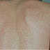 علاج الطفح الجلدي Urticaria علاج الطفح الجلدي Urticaria