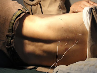 Acupuncture Therapy Acupuncture Therapy